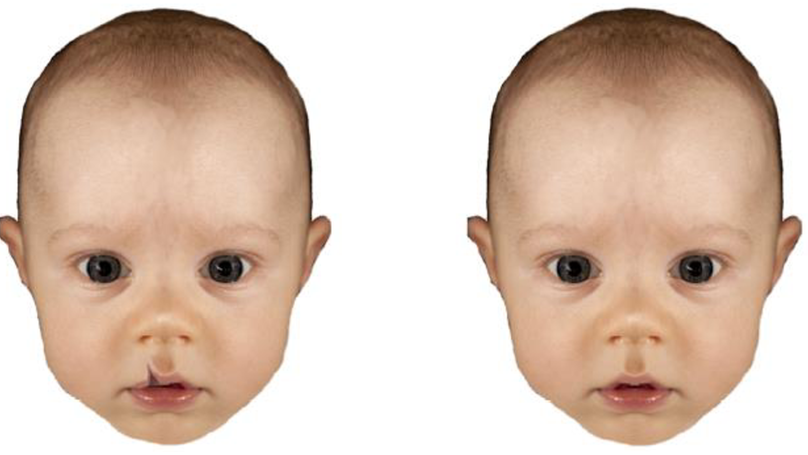 In the mind of the beholder: The effects of familiarisation on the perception of atypical infant facial configurations