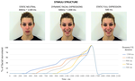 Facial expression time processing in typical development and in patients with congenital facial palsy